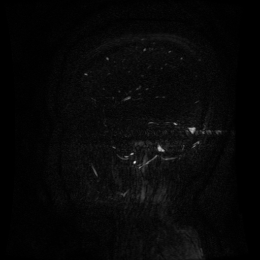 Normal noncontrast MR venography (Radiopaedia 87578-103957 A 34).jpg