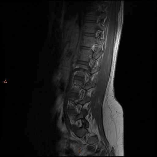 File:Normal spine MRI (Radiopaedia 77323-89408 Sagittal T1 4).jpg