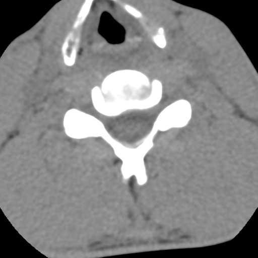 Normal trauma cervical spine (Radiopaedia 41017-43760 Axial non-contrast 38).png