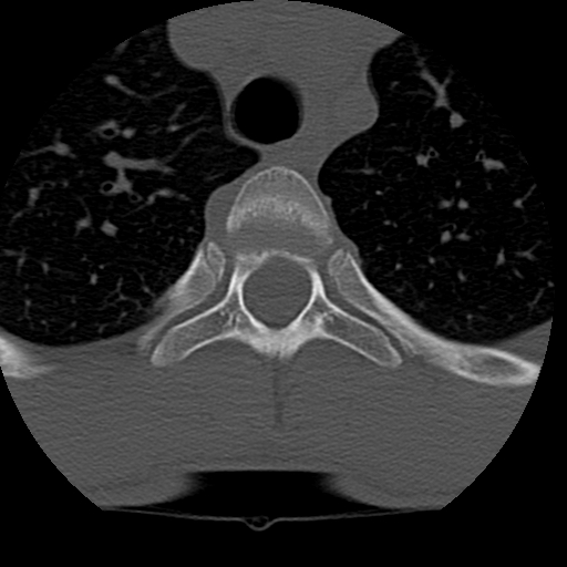 File:Normal trauma spine imaging (age 16) (Radiopaedia 45335-49358 Axial bone window 97).jpg