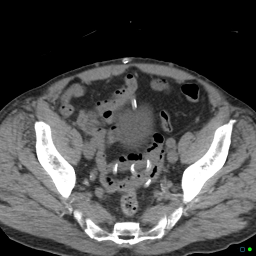 File:Obstructed Tenckhoff peritoneal dialysis catheter (Radiopaedia 37858-39789 Axial non-contrast 6).jpg