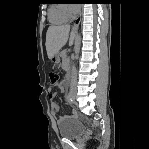 File:Obstructed kidney with perinephric urinoma (Radiopaedia 26889-27066 B 30).jpg