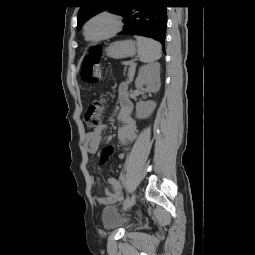 File:Obstructed kidney with perinephric urinoma (Radiopaedia 26889-27066 B 47).jpg