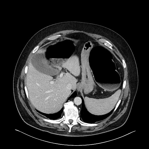 Obstructing sigmoid adenocarcinoma (Radiopaedia 58465-65619 A 34).jpg