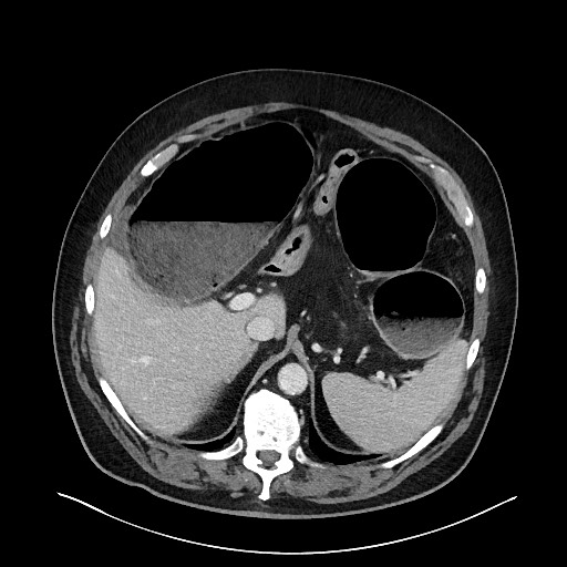 File:Obstructing sigmoid adenocarcinoma (Radiopaedia 58465-65619 A 42).jpg