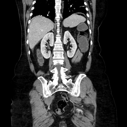 Obstructive distal colonic adenocarcinoma causing cecal perforation (Radiopaedia 86830-102989 C 124).jpg