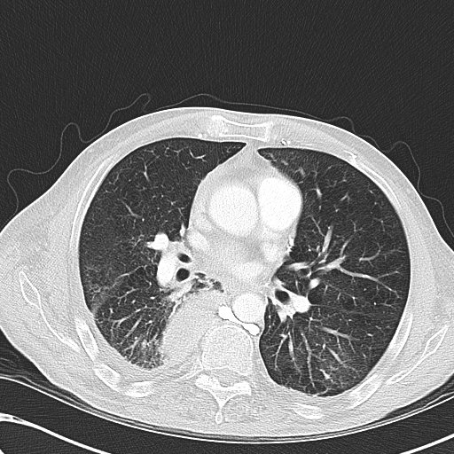 File:Obstructive superior vena cava tumor thrombus (Radiopaedia 28046-28306 Axial lung window 28).jpg