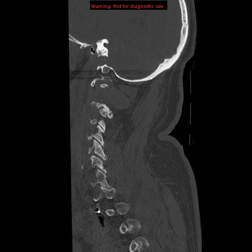 File:Occipital condyle fracture (Radiopaedia 18366-18208 Sagittal bone window 5).jpg