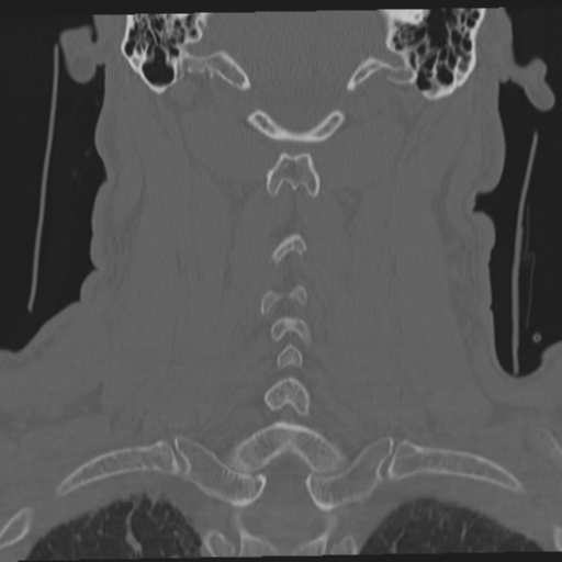 File:Occipital condyle fracture (Radiopaedia 33467-34517 Coronal bone window 46).png