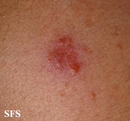 File:Sarcoidosis (Dermatology Atlas 29).jpg