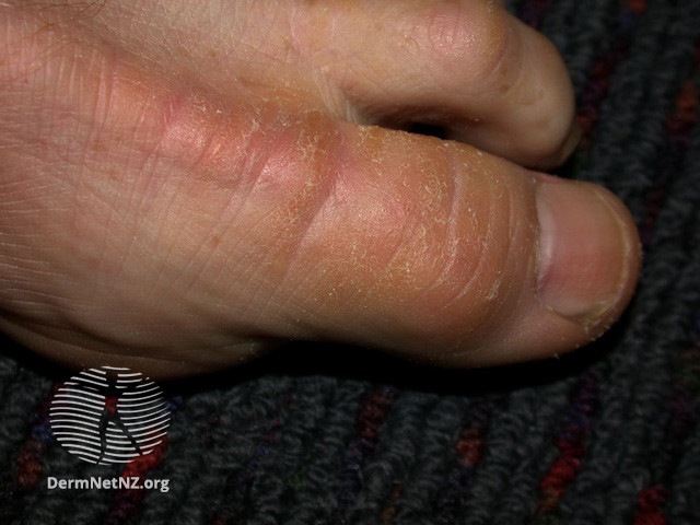 File:The important thing is to relieve the pressure on the affected area of skin. (DermNet NZ scaly-callus2).jpg
