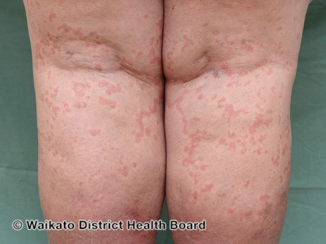 File:Urticaria (DermNet NZ systemic-w-itchy-skin-68).jpg