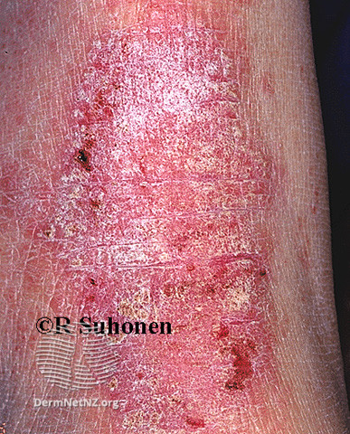 File:(DermNet NZ dermatitis-lichen-simplex-3125).jpg