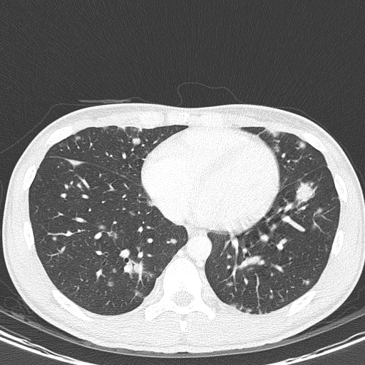 AIDS-related Kaposi sarcoma (Radiopaedia 85247-100811 Axial lung window 118).jpg