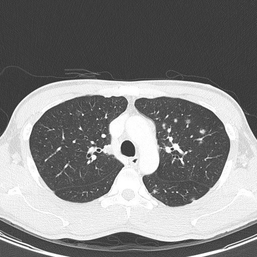 AIDS-related Kaposi sarcoma (Radiopaedia 85247-100811 Axial lung window 51).jpg