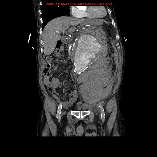 Abdominal aortic aneurysm- extremely large, ruptured (Radiopaedia 19882-19921 Coronal C+ arterial phase 41).jpg