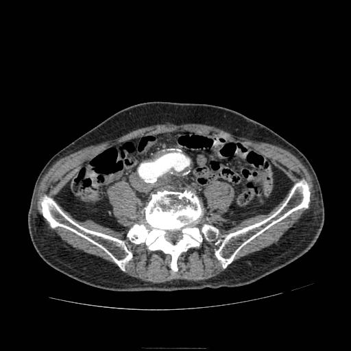Abdominal aortic aneurysm (Radiopaedia 13341-13340 Axial C+ arterial phase 156).jpg
