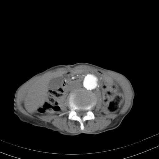 File:Abdominal aortic aneurysm (Radiopaedia 20827-20742 Axial C+ arterial phase 19).jpg