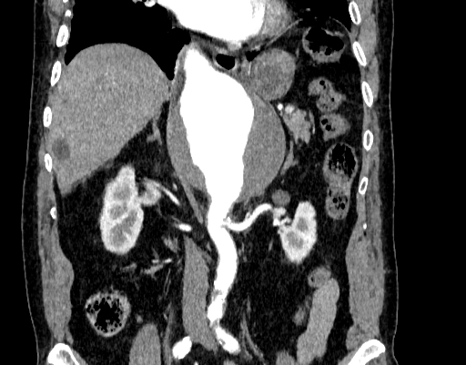 Abdominal aortic aneurysm (Radiopaedia 67117-76452 Coronal C+ arterial phase 51).jpg
