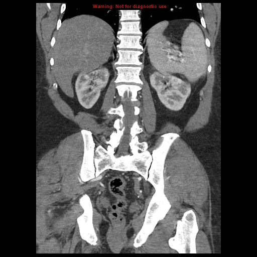 File:Abdominal aortic aneurysm (Radiopaedia 8190-9038 Coronal C+ arterial phase 92).jpg