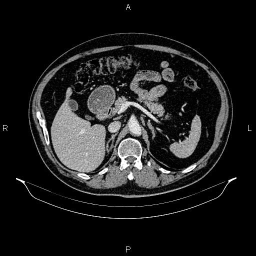Abdominal aortic aneurysm (Radiopaedia 83094-97462 Axial renal cortical phase 83).jpg