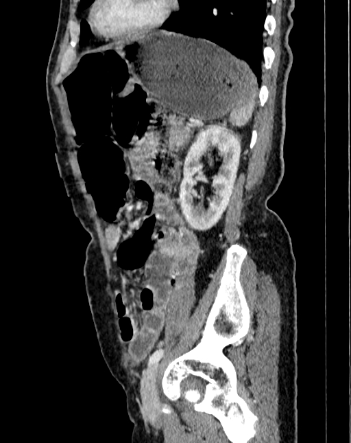 Abdominal aortic aneurysm (Radiopaedia 83581-98689 Sagittal C+ portal venous phase 99).jpg