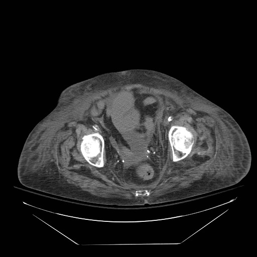 Abdominal aortic aneurysm - impending rupture (Radiopaedia 19233-19247 Axial non-contrast 148).jpg