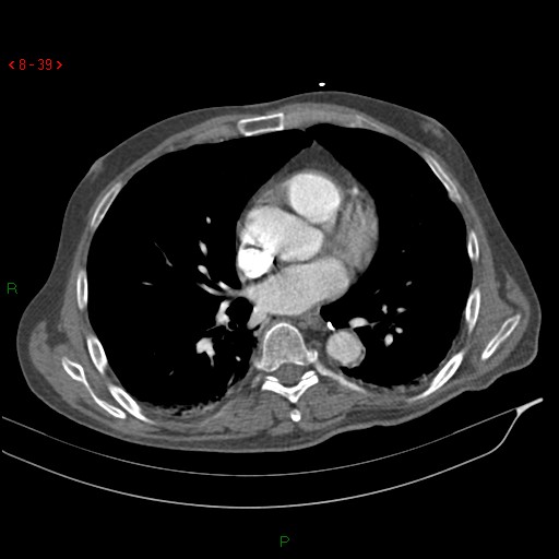 Abdominal aortic aneurysm rupture with aortocaval fistula (Radiopaedia 14897-14841 Axial C+ arterial phase 39).jpg