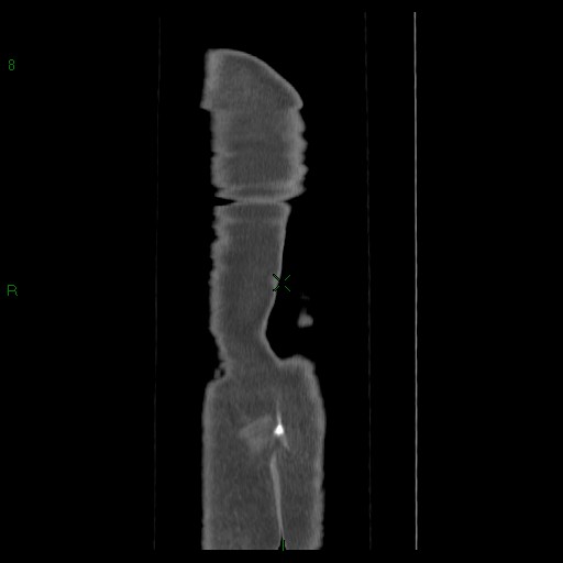 File:Abdominal aortic aneurysm rupture with aortocaval fistula (Radiopaedia 14897-14841 Coronal C+ arterial phase 41).jpg