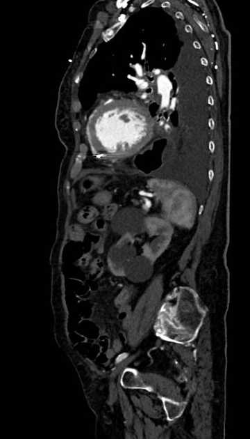 Abdominal aortic aneurysm with thrombus fissuration (Radiopaedia 73192-83919 Sagittal C+ arterial phase 38).jpg