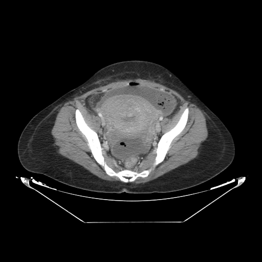 Abdominal gossypiboma- surgical towel (Radiopaedia 57288-64226 Axial C+ portal venous phase 64).jpg