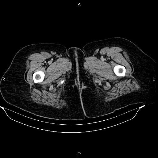 Abdominal lymphoma with sandwich sign (Radiopaedia 84378-99704 Axial C+ portal venous phase 64).jpg