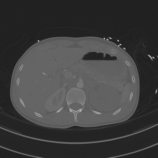 File:Abdominal multi-trauma - devascularised kidney and liver, spleen and pancreatic lacerations (Radiopaedia 34984-36486 I 94).png