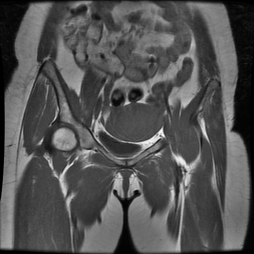 File:Abdominal wall endometriosis (Radiopaedia 83702-98847 Coronal T1 5).jpg