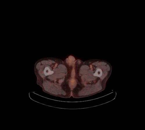 Abdominal wall metastasis from colorectal carcinoma (Radiopaedia 31016-31719 C 11).jpg
