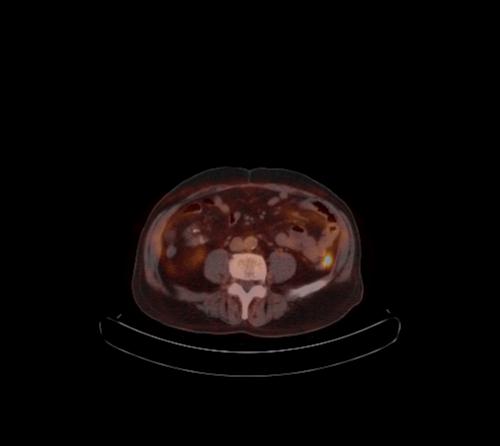 File:Abdominal wall metastasis from colorectal carcinoma (Radiopaedia 31016-31719 C 54).jpg