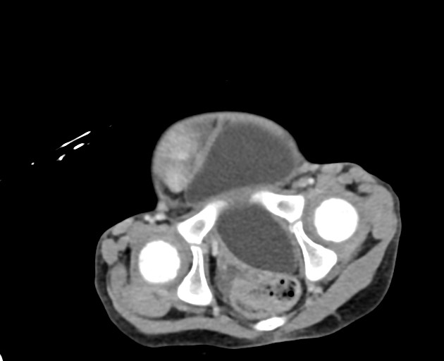 Abdominopelvic rhabdomyosarcoma (Radiopaedia 78356-90984 Axial C+ portal venous phase 148).jpg