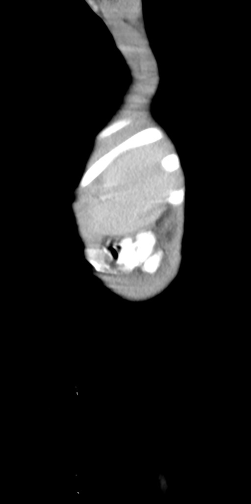 Abdominopelvic rhabdomyosarcoma (Radiopaedia 78356-90984 Sagittal C+ portal venous phase 9).jpg