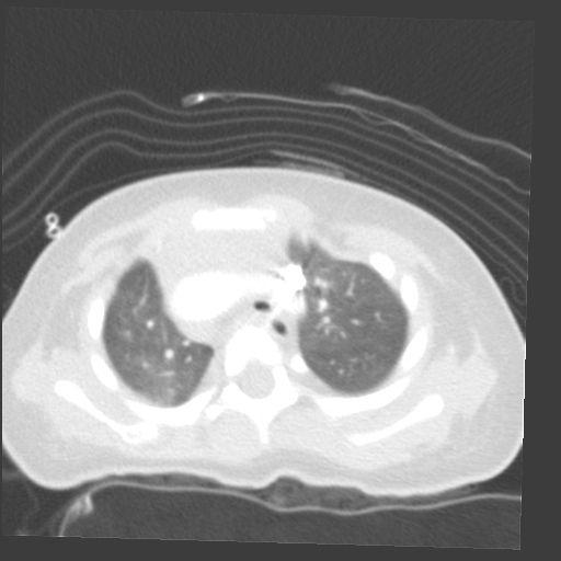 File:Aberrant left pulmonary artery (pulmonary sling) (Radiopaedia 42323-45435 Axial lung window 10).jpg