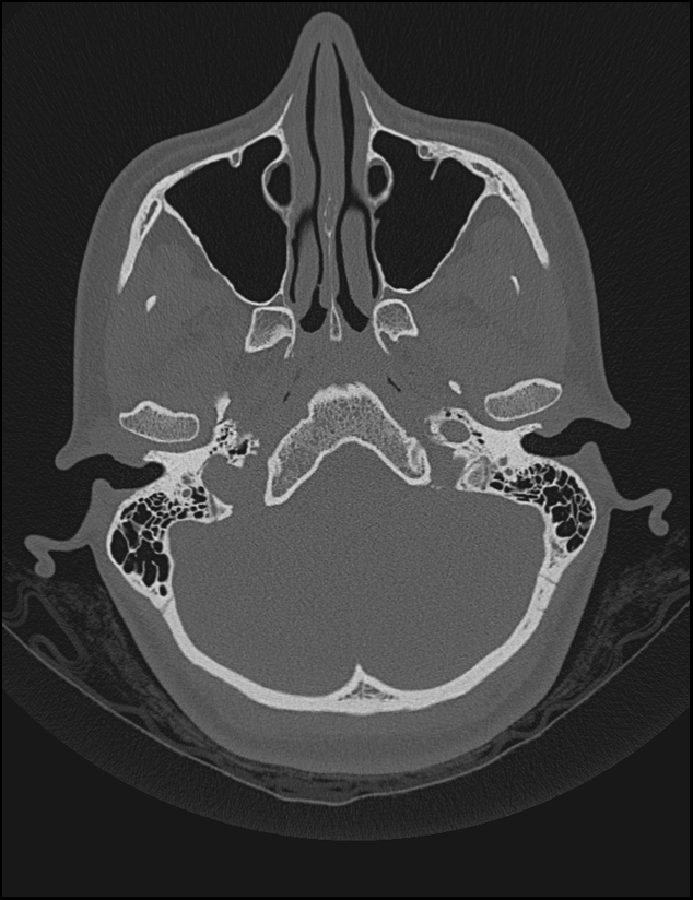 Aberrant right internal carotid artery (Radiopaedia 65191-74198 Axial non-contrast 28).jpg