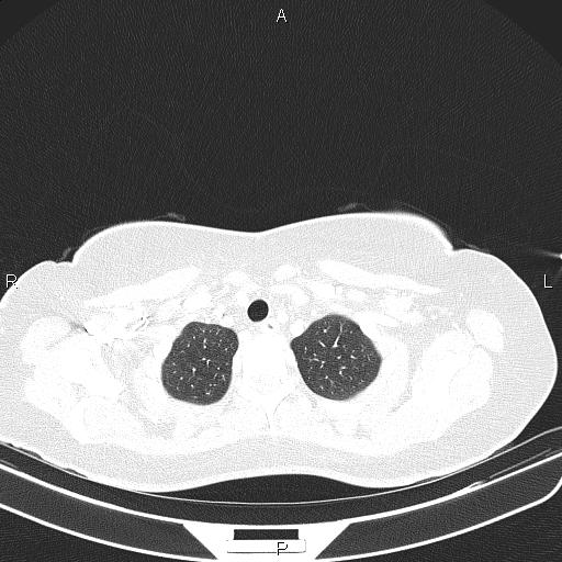 Aberrant right subclavian artery (Radiopaedia 87334-103629 Axial lung window 12).jpg