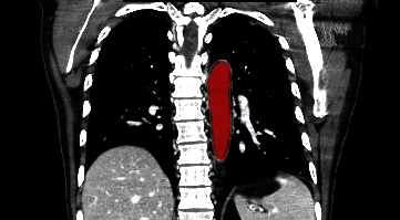 File:Aberrant right subclavian artery (Radiopaedia 9379-38993 Coronal 2).jpg