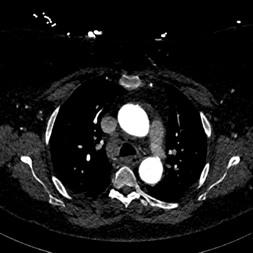 File:Aberrant right subclavian artery with Kommerell diverticulum (Radiopaedia 47982-52769 Axial C+ arterial phase 32).png
