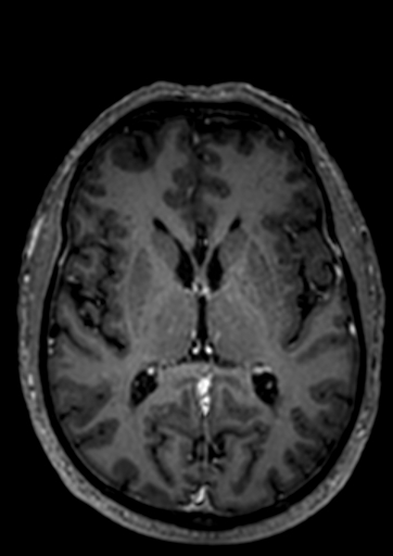 File:Accessory middle cerebral artery (Radiopaedia 73114-83828 Axial T1 C+ 23).jpg