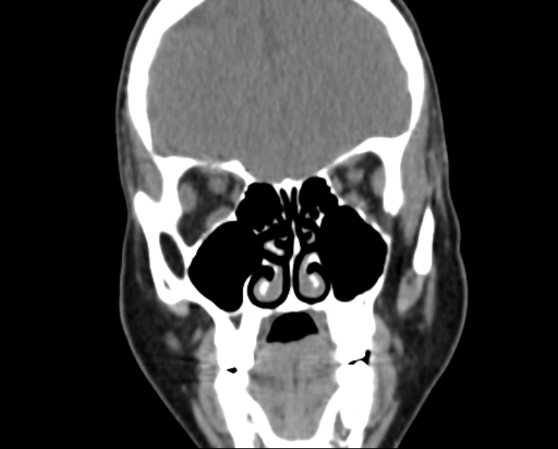Accessory parotid gland (Radiopaedia 76207-87772 Coronal non-contrast 35).jpg