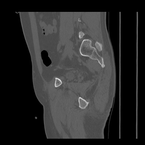 Acetabular and ilial fractures (Radiopaedia 59084-66378 Sagittal bone window 64).jpg