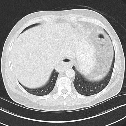 File:Achalasia of the cardia (Radiopaedia 38497-40595 Axial lung window 44).png