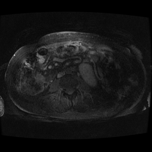 Acinar cell carcinoma of the pancreas (Radiopaedia 75442-86668 Axial late phase (~30 mins) 2).jpg