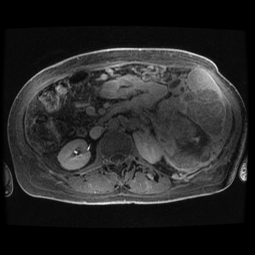 Acinar cell carcinoma of the pancreas (Radiopaedia 75442-86668 Axial late phase (~30 mins) 37).jpg