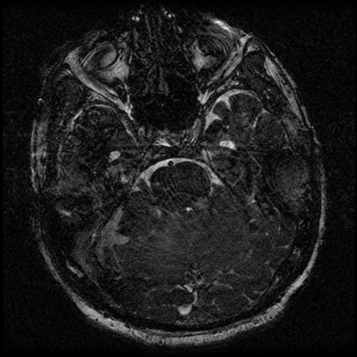 File:Acoustic schwannoma (Radiopaedia 39170-41387 Axial FIESTA 91).png